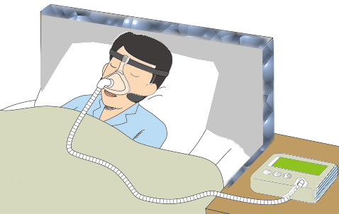 たつみの歯科クリニックの睡眠時無呼吸症候群治療 CPAP装置