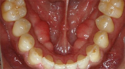 たつみの歯科クリニックの睡眠時無呼吸症候群治療 歯ぎしりによるむし歯