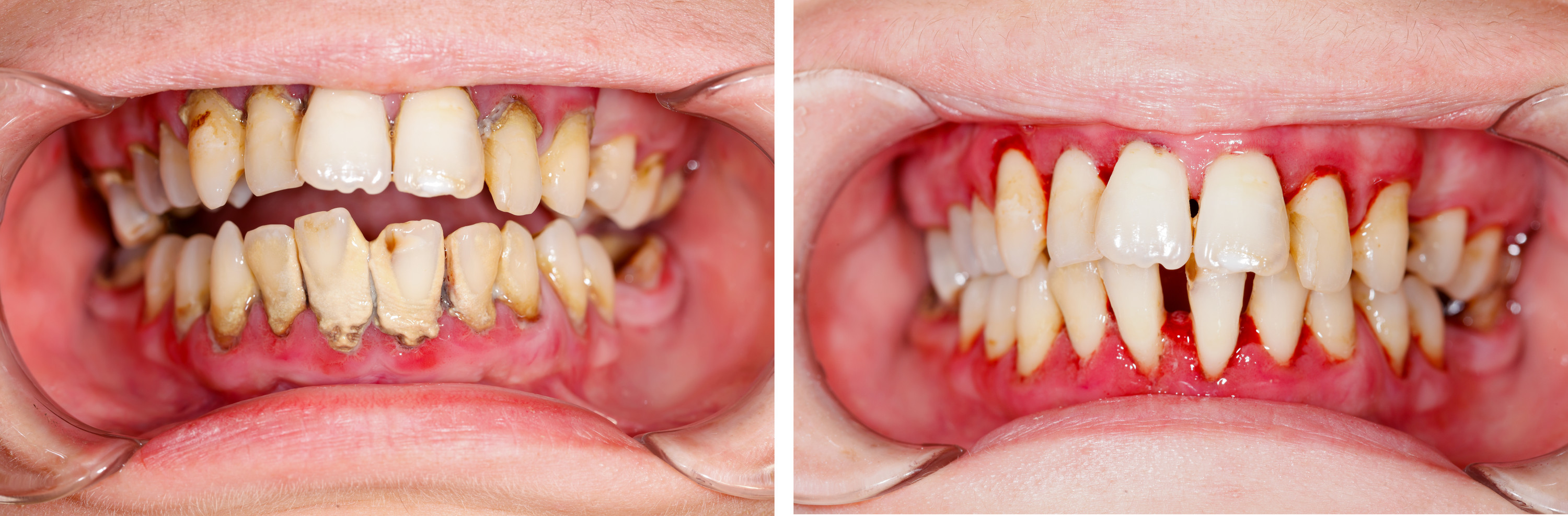 たつみの歯科クリニックの歯周病治療2