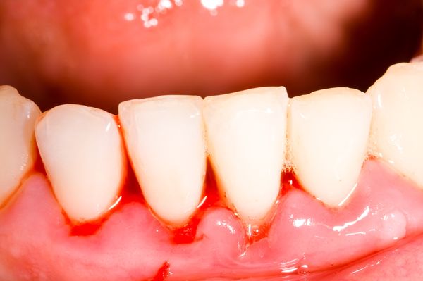 たつみの歯科クリニックの歯周病治療4