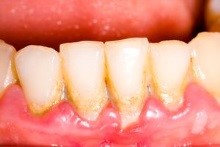たつみの歯科クリニックの歯周病治療5