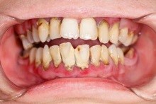 たつみの歯科クリニックの歯周病治療6