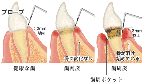 たつみの歯科クリニックの歯周病治療4