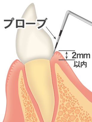 たつみの歯科クリニックの歯周病治療